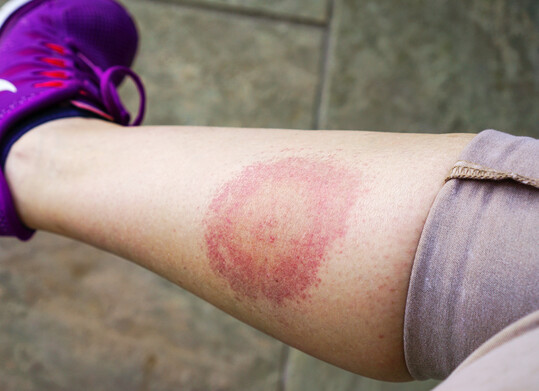 R�tung nach einem Zeckenbiss am Bein eines Menschen, Borreliose (auch Lyme-Borreliose oder Lyme-Krankheit genannt).